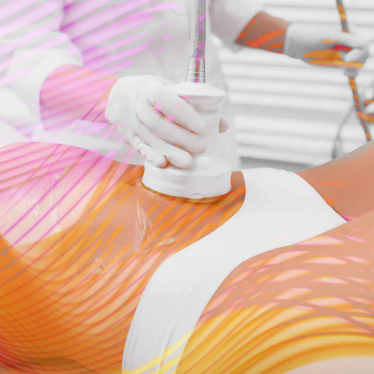 Cavitation